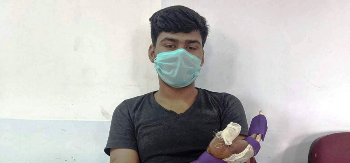चुँडिएको हात १० घण्टाको लामो शल्यक्रियापछि जोडियो