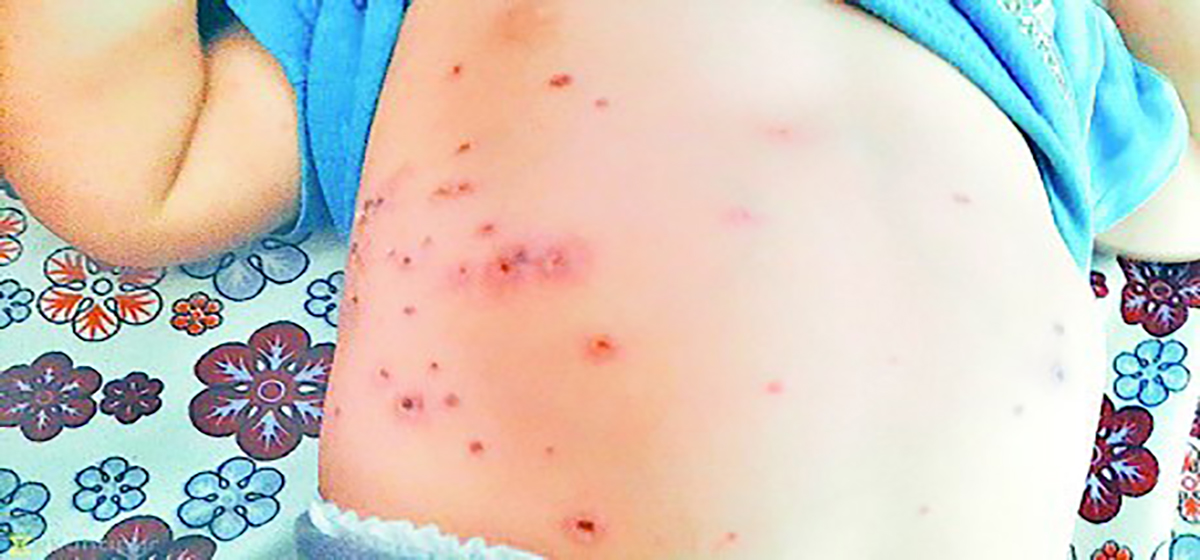बैतडीमा एक महिनामा स्क्रब टाइफसका ४९ जना बिरामी फेला