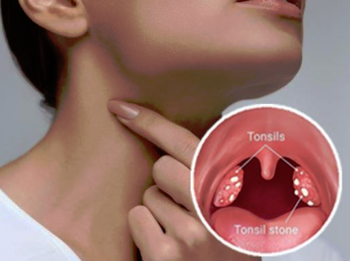 टन्सिलले मुटुरोग निम्त्याउन सक्छ