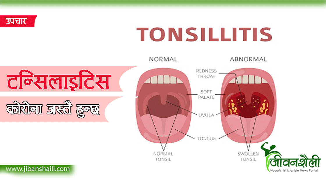 कोरोना जस्तै  लक्षण देखिन्छ ‘टन्सिलाइटिस’ को पनि