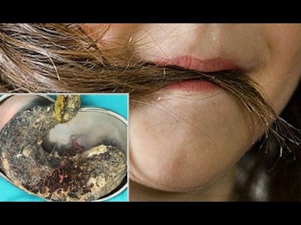 आफ्नै कपाल खाने लतमा परेकी महिलाको पेटबाट निकालियो ‘कपालको बल’